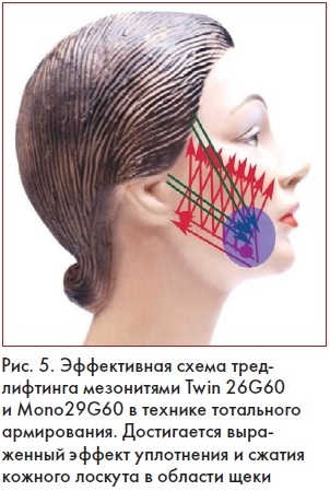 Эффективная схема тредлифтинга мезонитями Beaute’ lift V LINE: Twin 26G60 и Mono29G60 в технике тотального армирования. Достигается выраженный эффект уплотнения и сжатия кожного лоскута в области щек 15